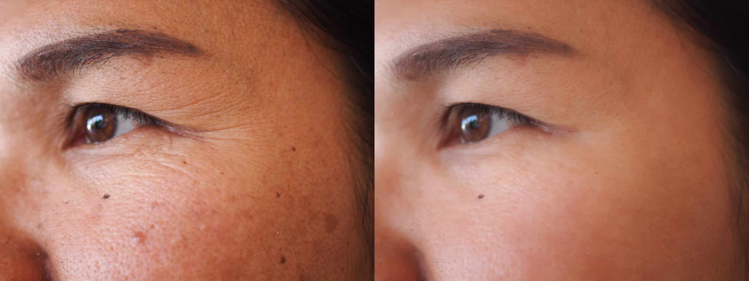 Image,Before,And,After,Treatment,Rejuvenation,Surgery,On,Face,Asian