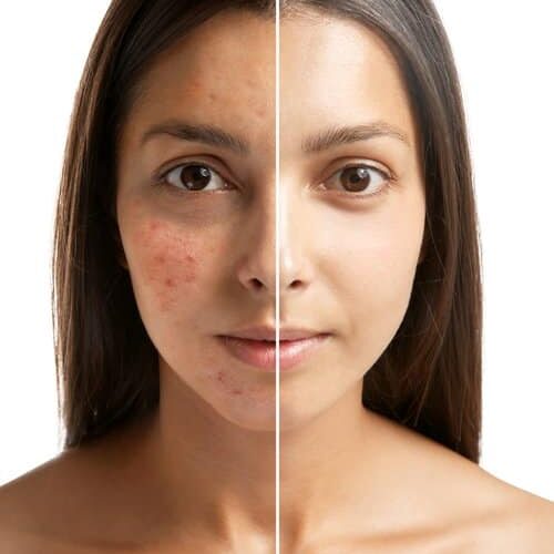 Woman,Face,Before,And,After,Acne,Treatment,Procedure.,Skin,Care